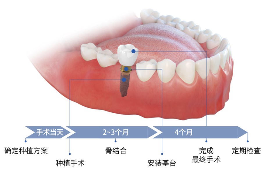 上海种植牙怎么选医院？医生整理好又便宜的正规机构指南（城本/鼎植/薇琳伯曼/中喜/西郊众植）