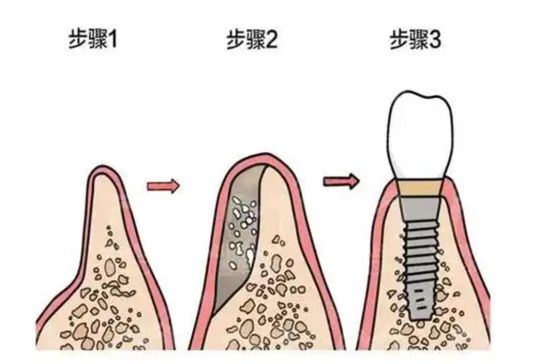 种植牙一共花多少钱含骨粉/牙冠/复查｜2026集采后全包价拆解+避坑指南