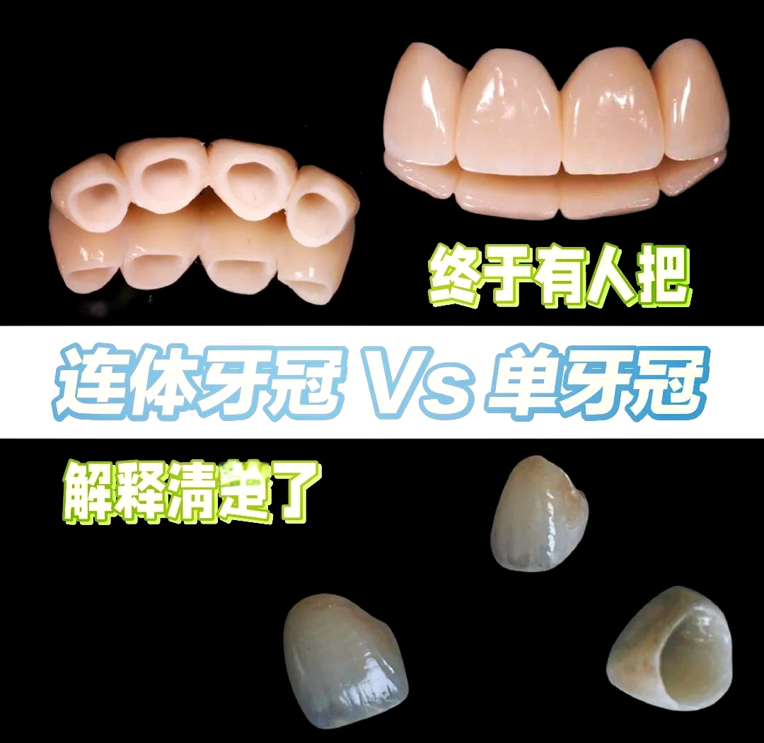把种牙当成“买房”，把镶牙当成“租房”？10年后算完这笔账，我沉默了…