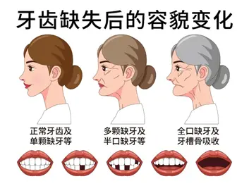 啃不动排骨、脸塌显老10岁？镶牙省下的几千块，最后全交给整形科了！🦷➡️💉