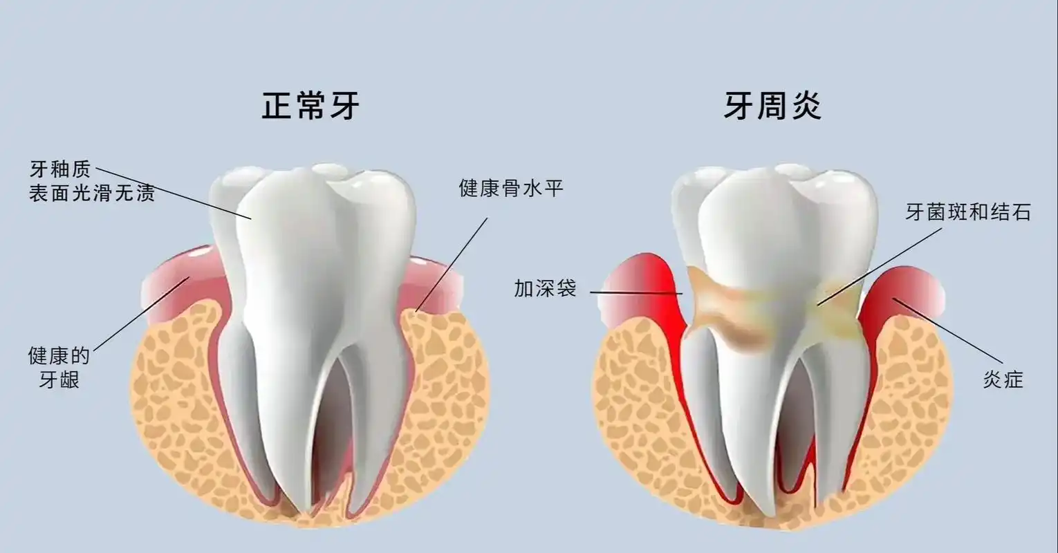 长期牙周炎不治不仅口臭!小心这 3 种全身性慢性病找上门
