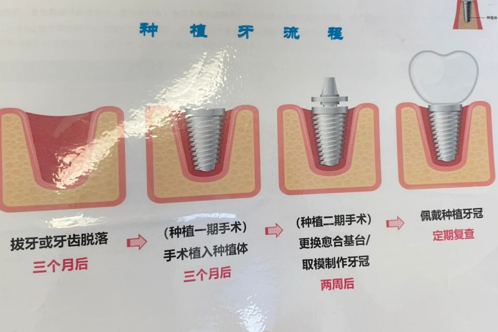 种植牙多少钱一颗?深度科普:从价格构成到避坑指南